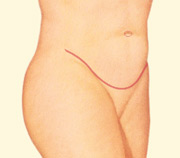 Tummy Tuck, Lower Incision