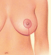 Horizontally along the breast crease, incision